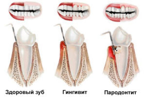 Пародонтит