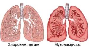 Муковисцидоз