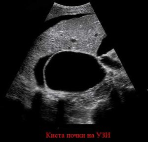 Киста почки