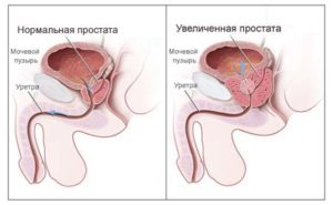 Аденома простаты