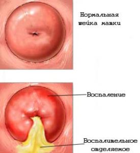 Цервицит