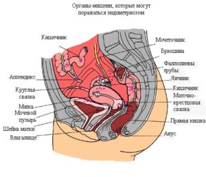 Эндометриоз