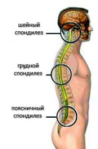 Спондилез
