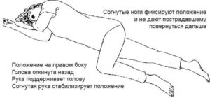 Сотрясение головного мозга