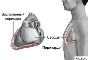 Перикардит