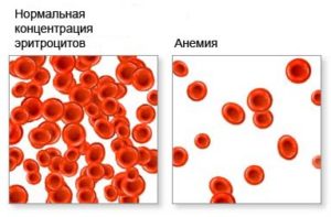 Анемия железодефицитная