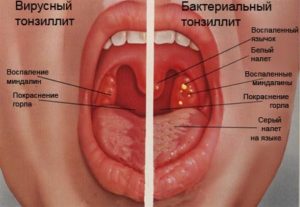 Тонзиллит