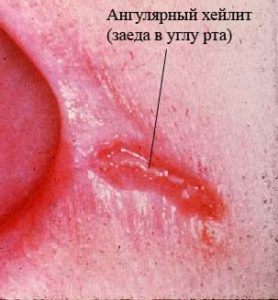 Хейлит (заеда)