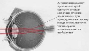 Астигматизм