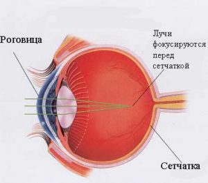 Миопия