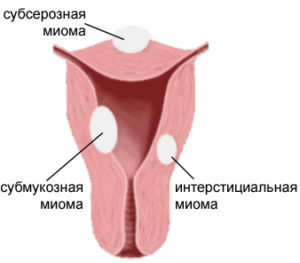 Миома матки