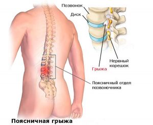 Грыжа поясничного отдела