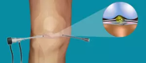 Как работает артроскоп?